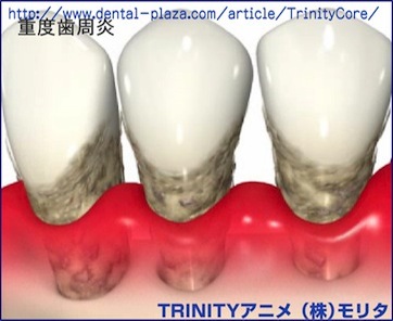 歯周病・歯肉炎の進行の具合