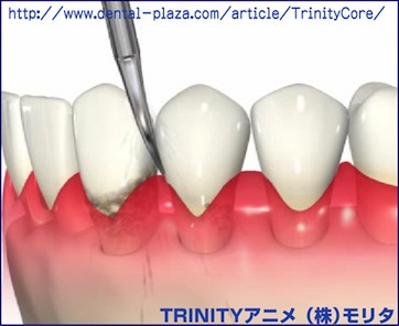 歯周病・歯肉炎の治療の経過